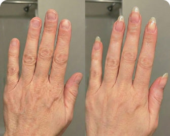Before and after nail result