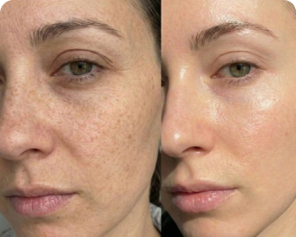 Before and after skin result